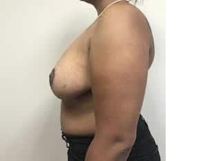 Breast Reduction Paramus NJ