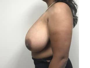 Before Image: Breast Reduction Paramus NJ - other