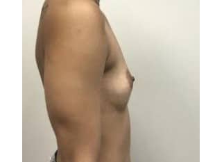 Breast Augmentation, Paramus, NJ
