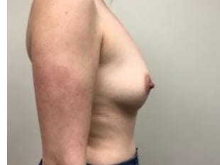 Breast Augmentation Paramus, NJ