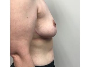 After Image: Breast Reduction Paramus, NJ - front