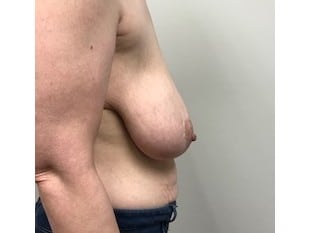 Before Image: Breast Reduction Paramus, NJ - front