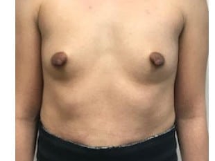 Before Image: Breast Augmentation Paramus, NJ - front
