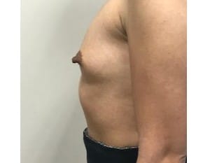 Before Image: Breast Augmentation Paramus, NJ - other