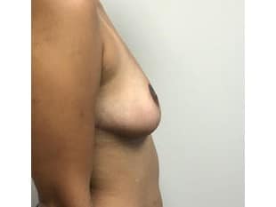 Title Breast Reduction Paramus NJ