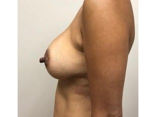 Breast Augmentation Bergen County NJ