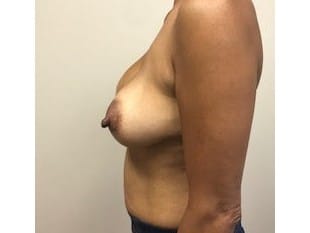 Breast Augmentation Bergen County NJ