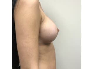 After Image: Breast Augmentation Bergen County NJ - other