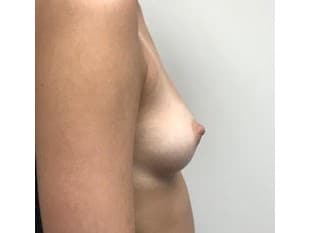 Breast Augmentation Bergen County NJ