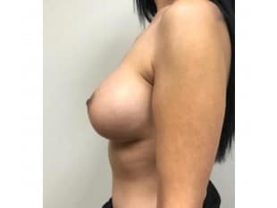 Breast Augmentation Bergen County NJ