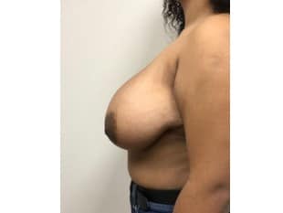 Breast Reduction Bergen County NJ