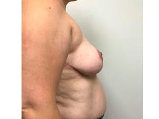 Breast Reduction Paramus, NJ