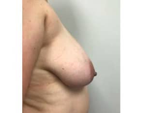 Breast Reduction Paramus, NJ