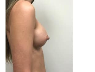 Breast Augmentation Bergen County NJ
