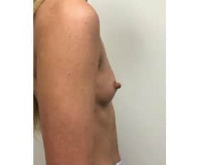 Breast Augmentation Bergen County NJ
