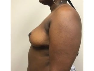 Breast Reduction, Paramus NJ