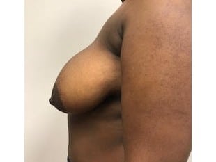 Breast Reduction, Paramus NJ