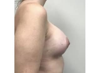 Breast Augmentation Bergen County NJ