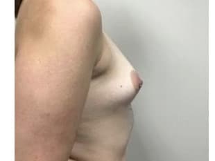 Breast Augmentation Bergen County NJ