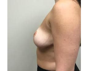 Breast Reduction Paramus