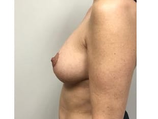 Breast Reduction Paramus, NJ