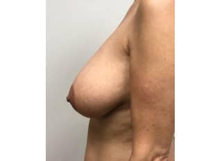 Breast Reduction Paramus, NJ