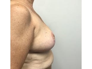 Breast Reduction, Paramus NJ