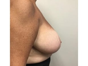 Breast Reduction, Paramus NJ