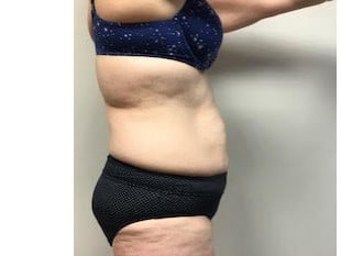 Before and 1 year after a full abdominoplasty with liposuction to the hips
