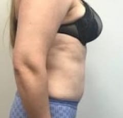 Abdominoplasty New Jersey