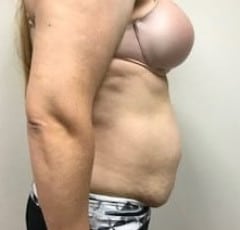Abdominoplasty New Jersey