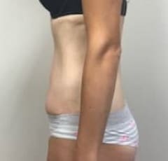 Abdominoplasty Bergen County NJ