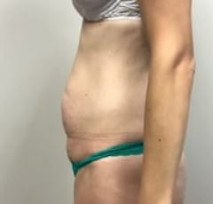 Abdominoplasty Bergen County NJ