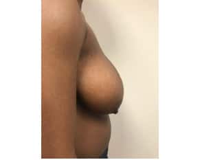 Breast reduction New Jersey