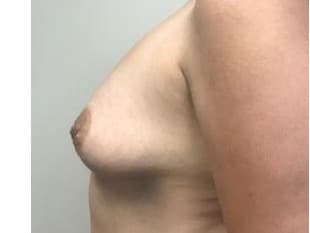 Breast Augmentation New Jersey