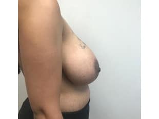 Breast Reduction NJ