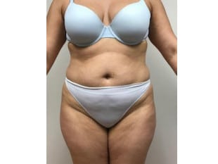 Liposuction Bergen County