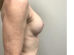 After Image: Breast Augmentation, Paramus NJ - front