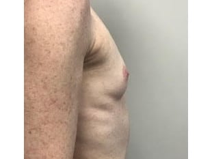 Before Image: Breast Augmentation, Paramus NJ - front