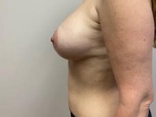 Breast Augmentation Bergen County