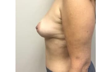 Breast Augmentation Bergen County