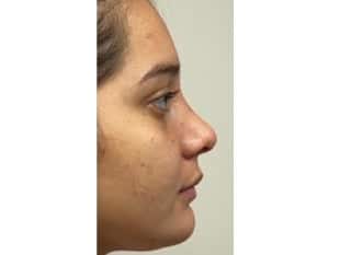 Rhinoplasty