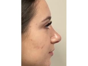 Rhinoplasty