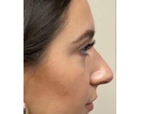 Rhinoplasty