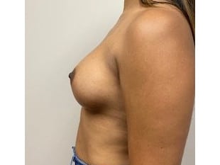 Breast Augmentation