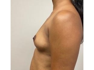 Breast Augmentation