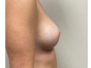 Breast Augmentation NJ