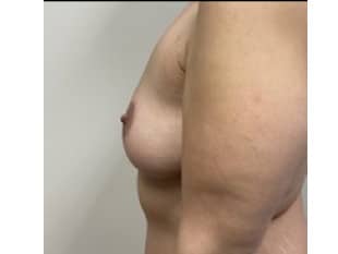 Breast Reduction New Jersey
