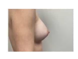 Breast Augmentation New Jersey