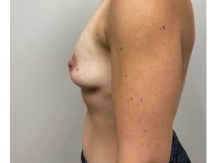 Breast Augmentation Bergen County